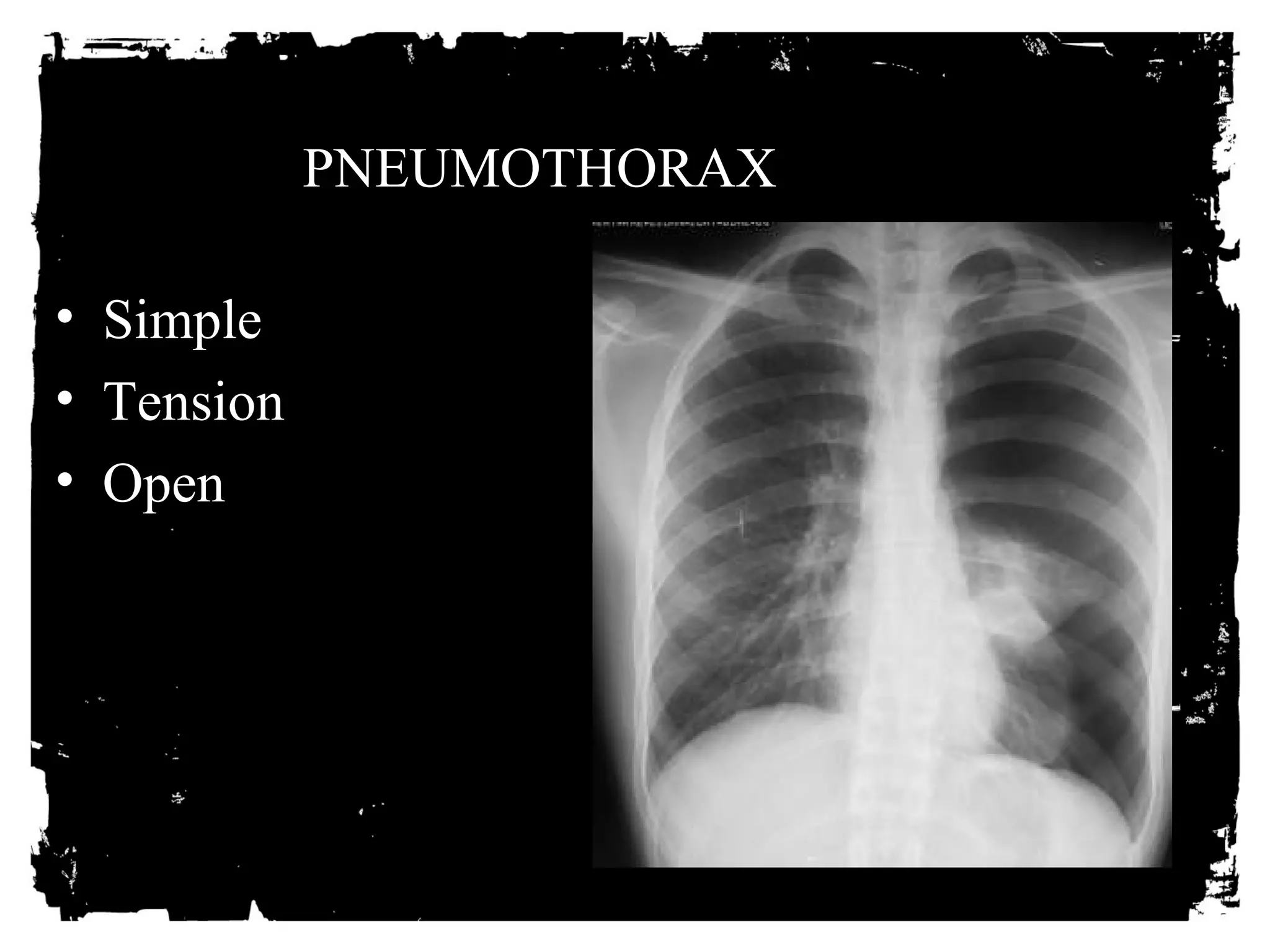 PNEUMOTHORAX 
• Simple 
• Tension 
• Open 
 