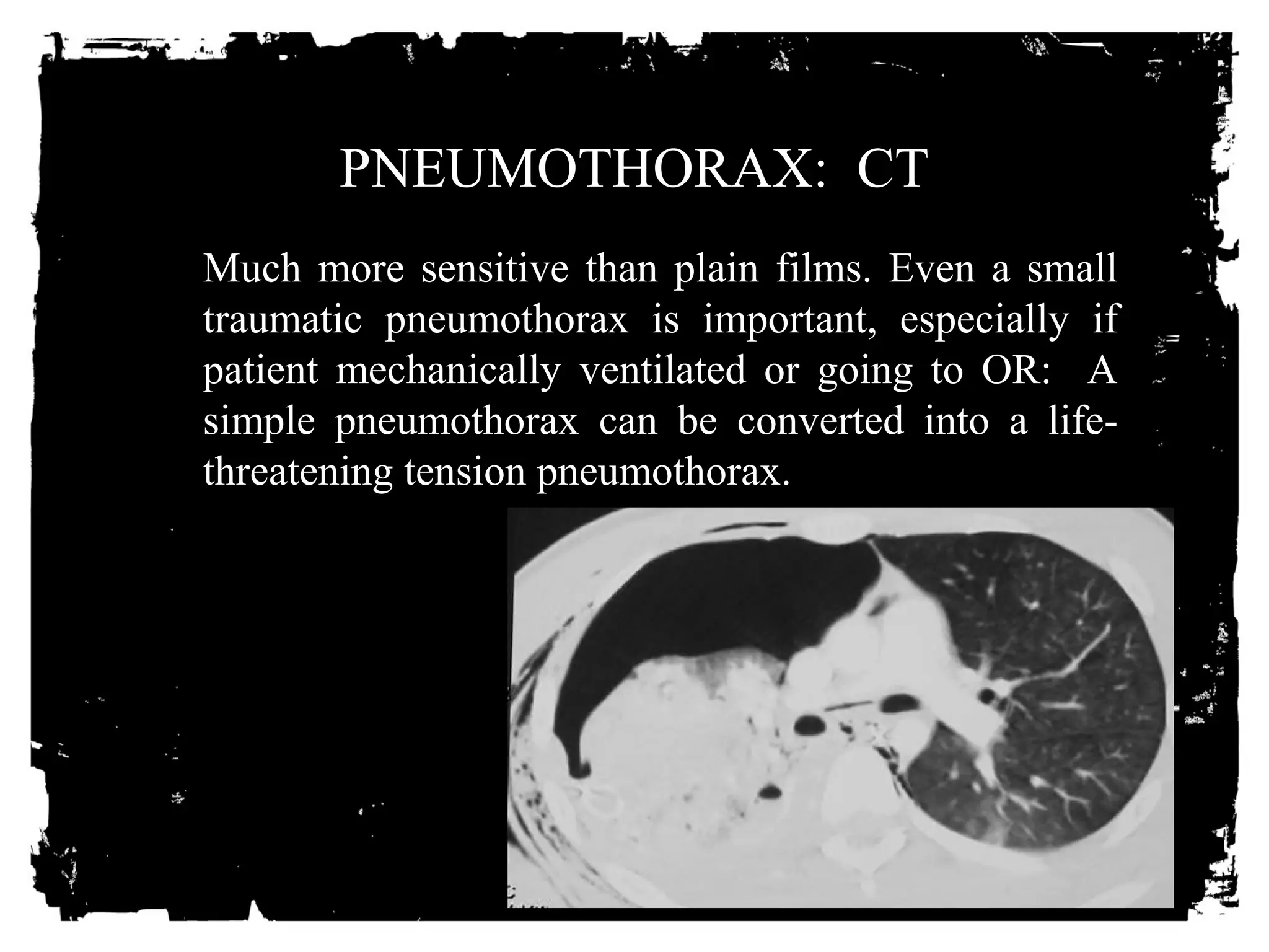 PNEUMOTHORAX: CT 
Much more sensitive than plain films. Even a small 
traumatic pneumothorax is important, especially if 
patient mechanically ventilated or going to OR: A 
simple pneumothorax can be converted into a life-threatening 
tension pneumothorax. 
 