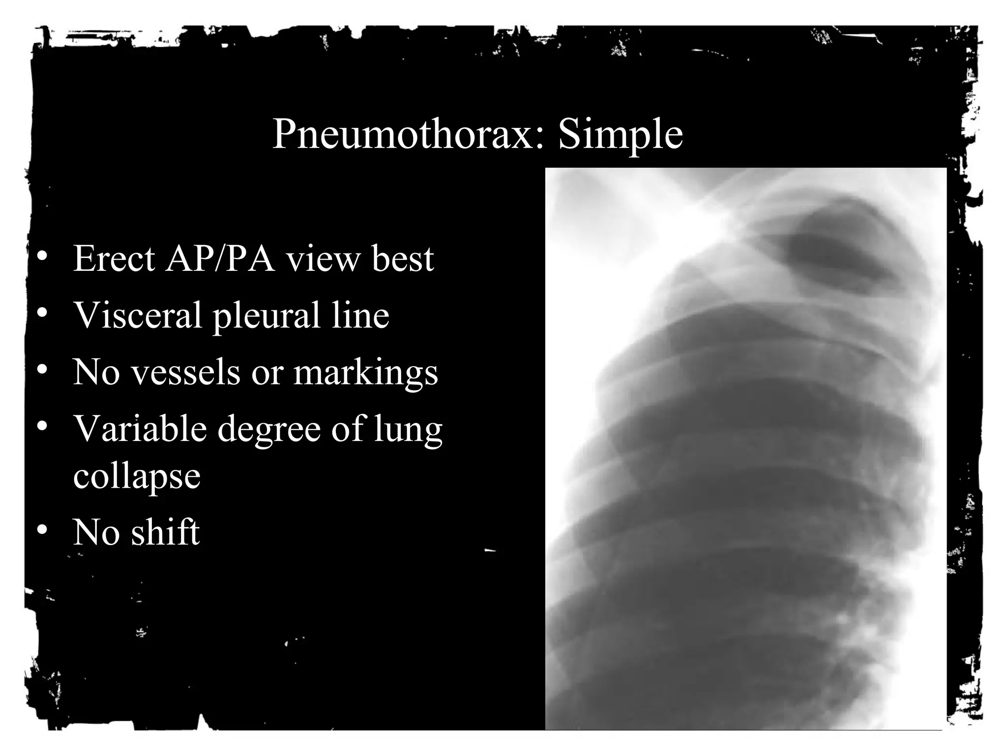 Pneumothorax: Simple 
• Erect AP/PA view best 
• Visceral pleural line 
• No vessels or markings 
• Variable degree of lung 
collapse 
• No shift 
 