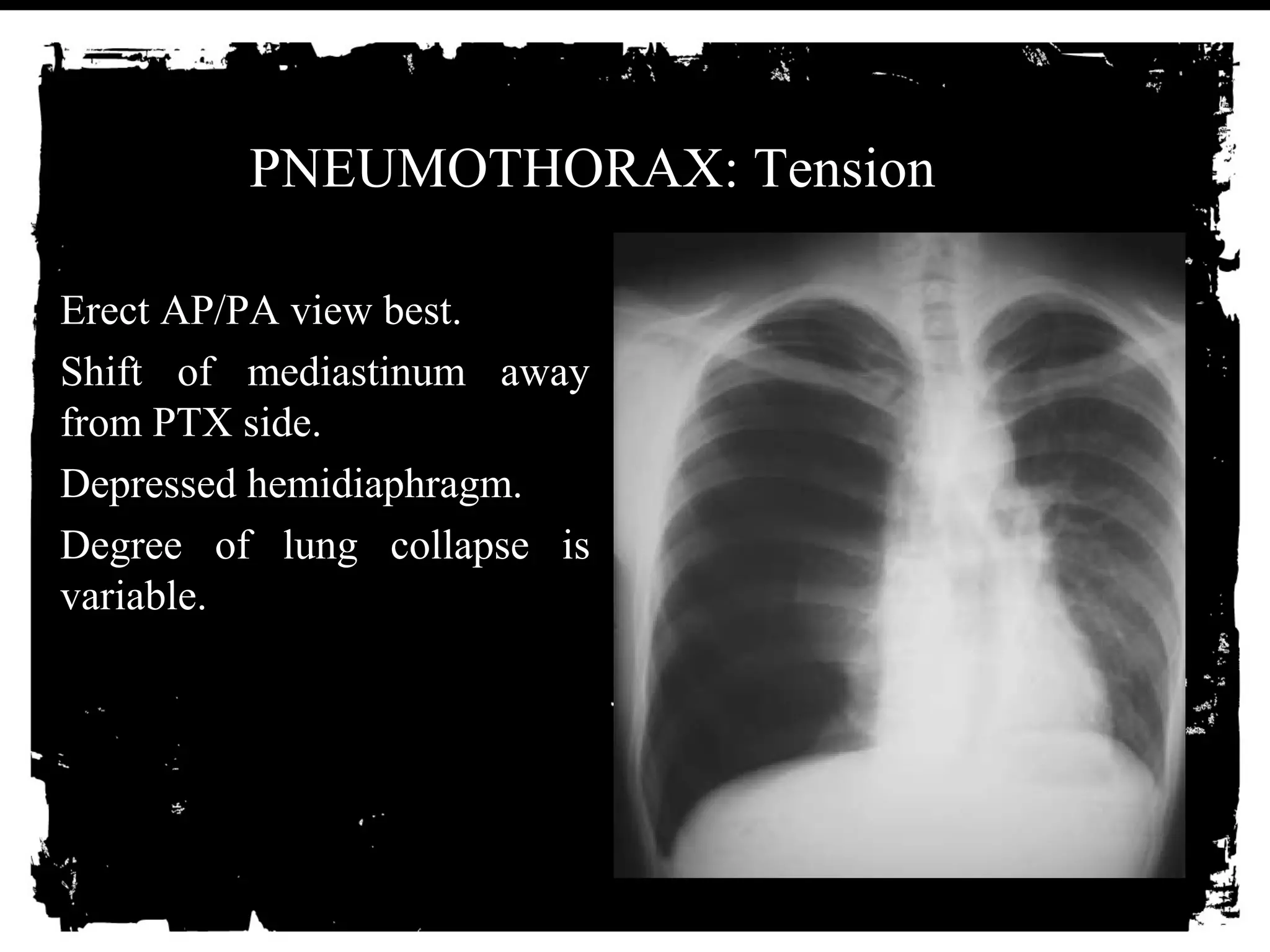 PNEUMOTHORAX: Tension 
• Erect AP/PA view best. 
• Shift of mediastinum away 
from PTX side. 
• Depressed hemidiaphragm. 
• Degree of lung collapse is 
variable. 
 