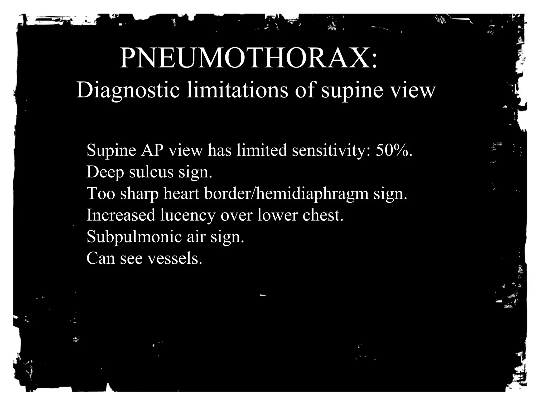 PNEUMOTHORAX: 
Diagnostic limitations of supine view 
Supine AP view has limited sensitivity: 50%. 
Deep sulcus sign. 
Too sharp heart border/hemidiaphragm sign. 
Increased lucency over lower chest. 
Subpulmonic air sign. 
Can see vessels. 
 