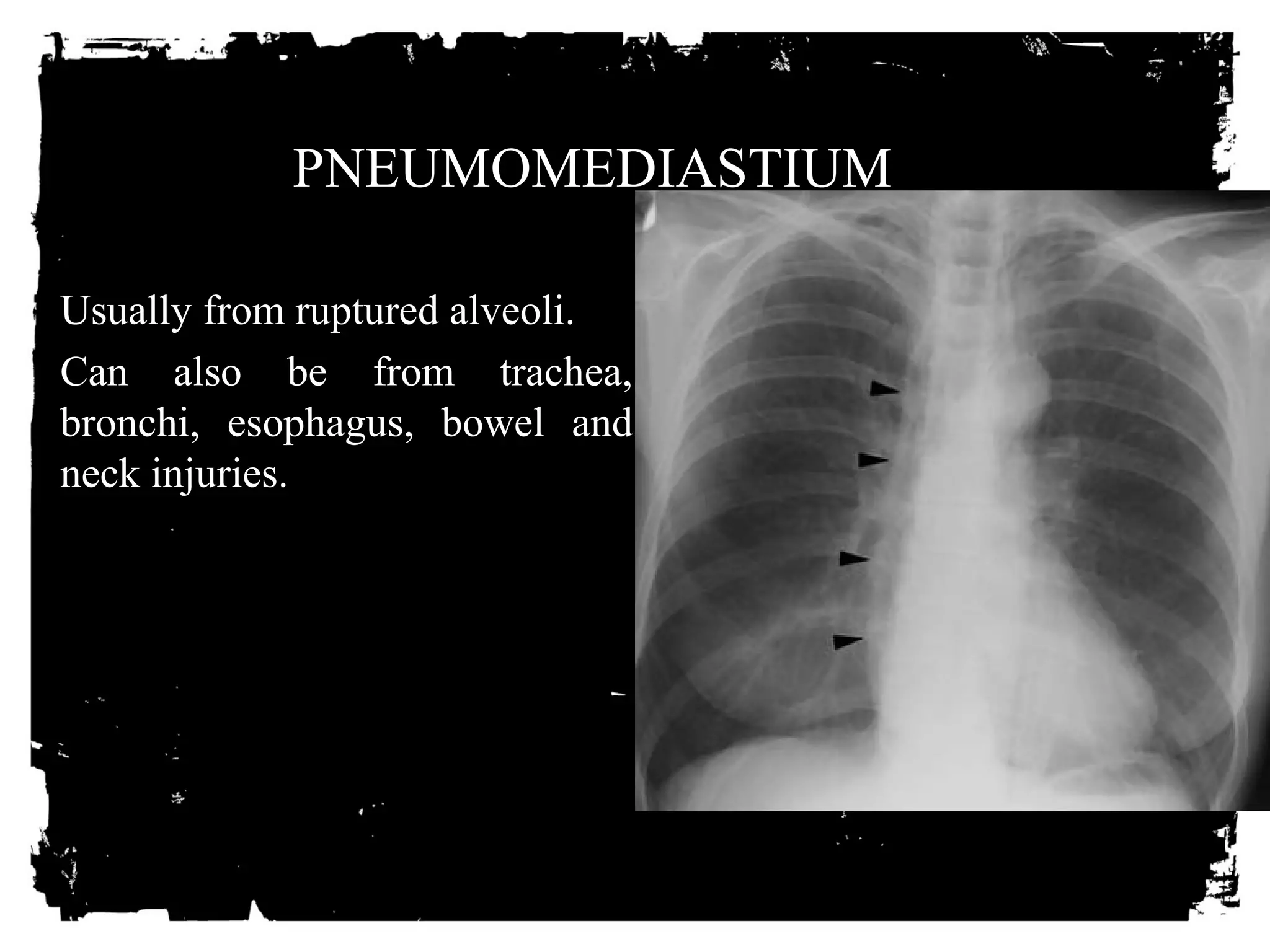 PNEUMOMEDIASTIUM 
• Usually from ruptured alveoli. 
• Can also be from trachea, 
bronchi, esophagus, bowel and 
neck injuries. 
 