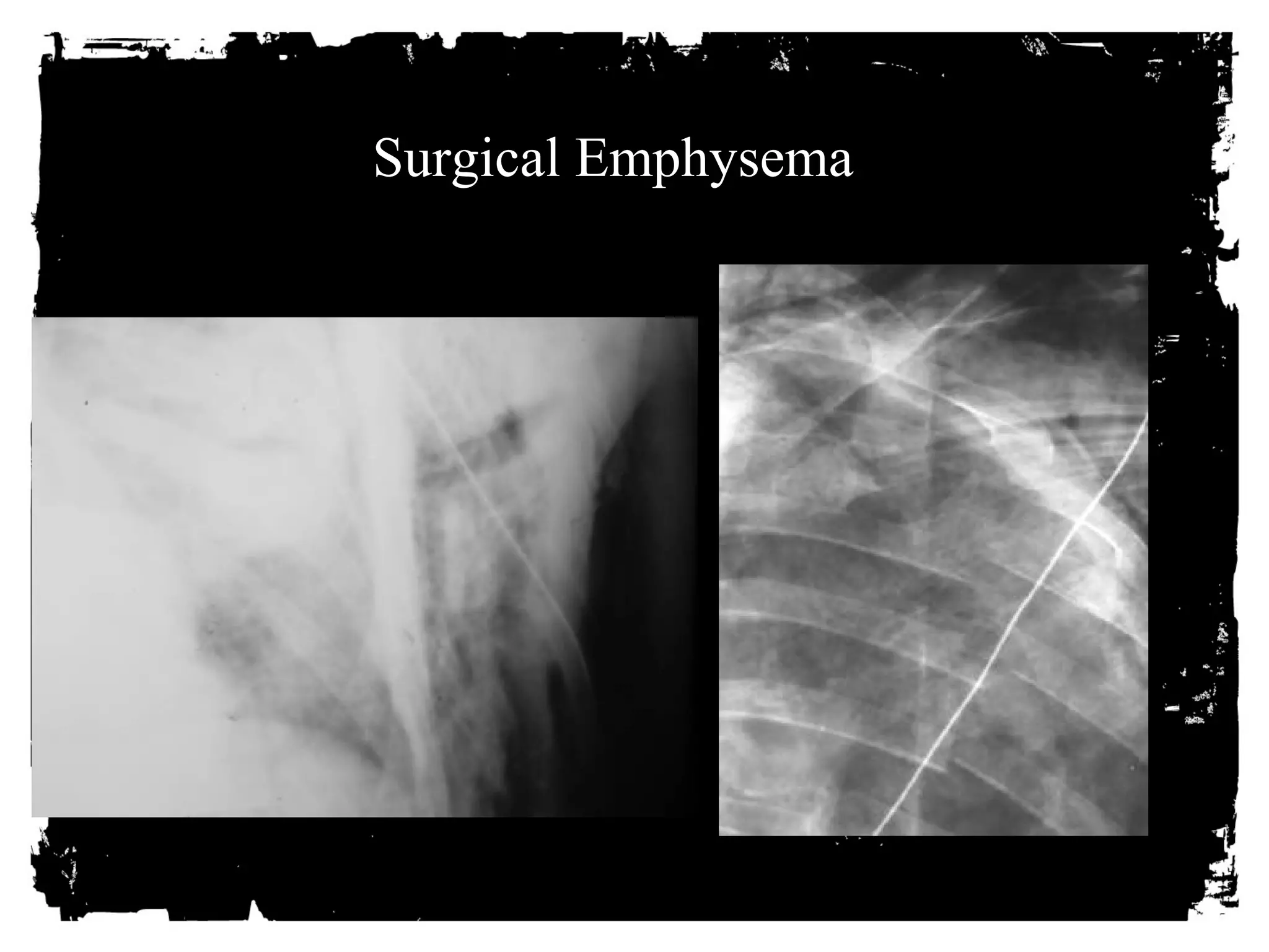 Surgical Emphysema 
 
