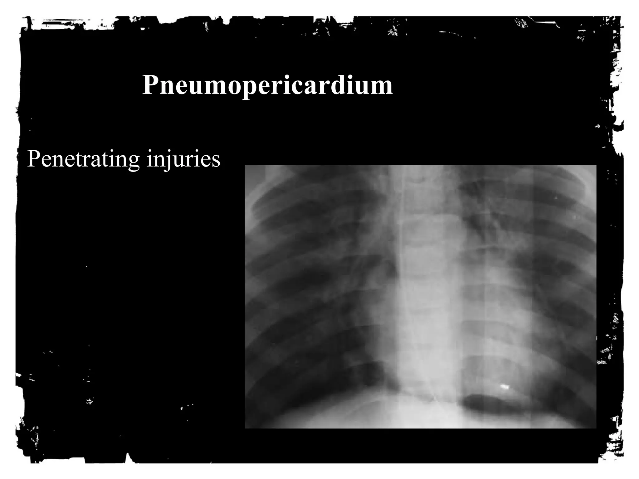 Pneumopericardium 
Penetrating injuries 
 