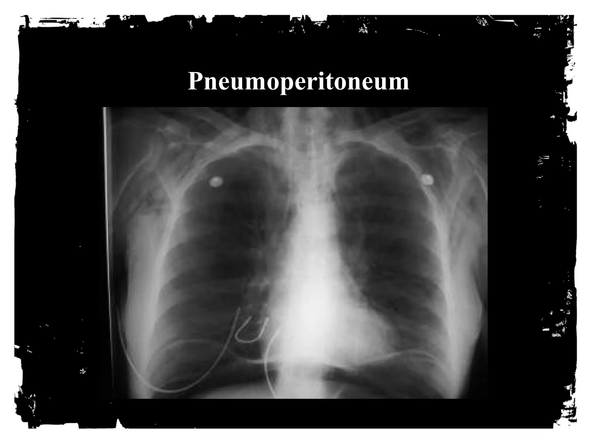 Pneumoperitoneum 
 