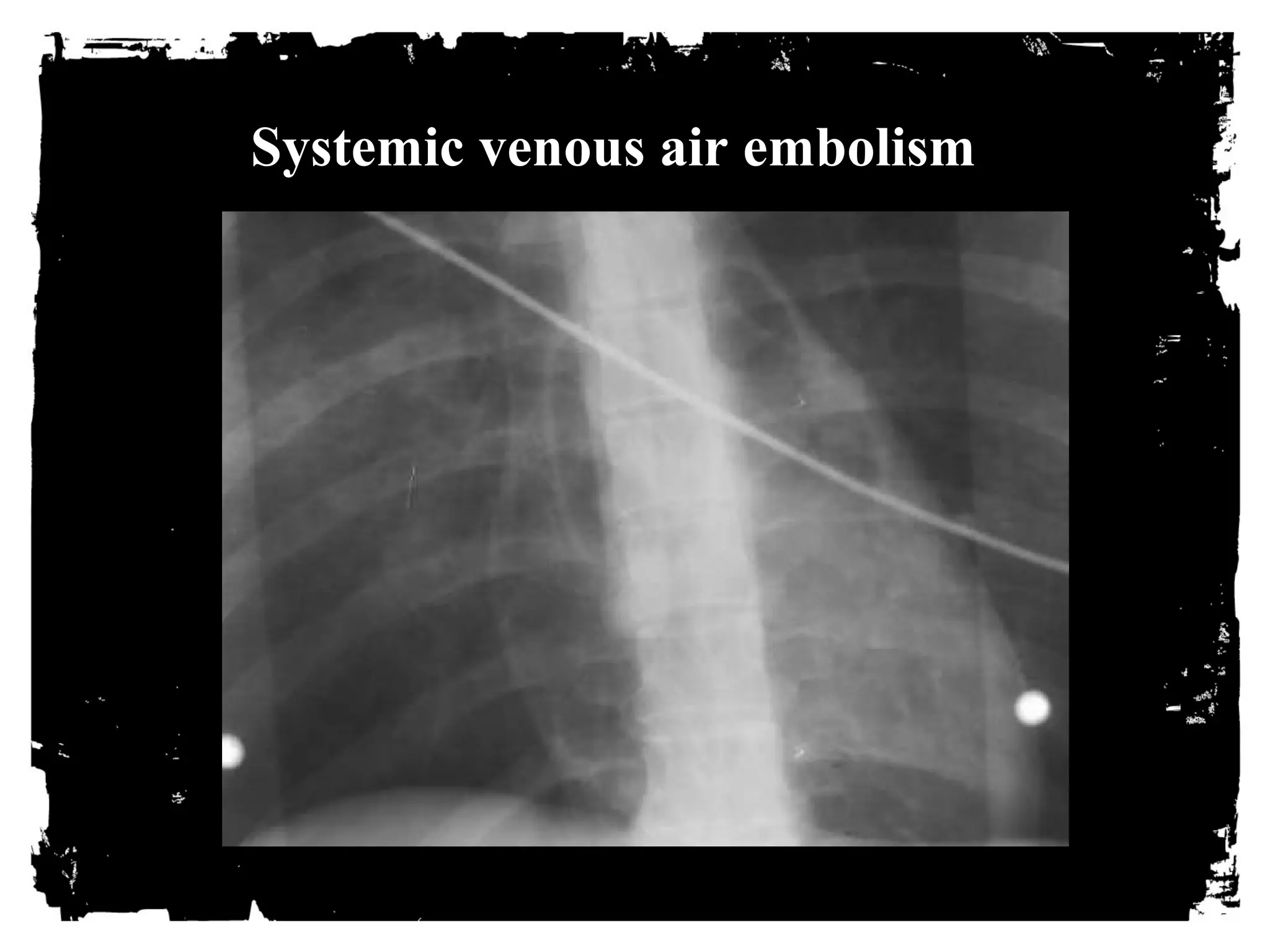 Systemic venous air embolism 
 