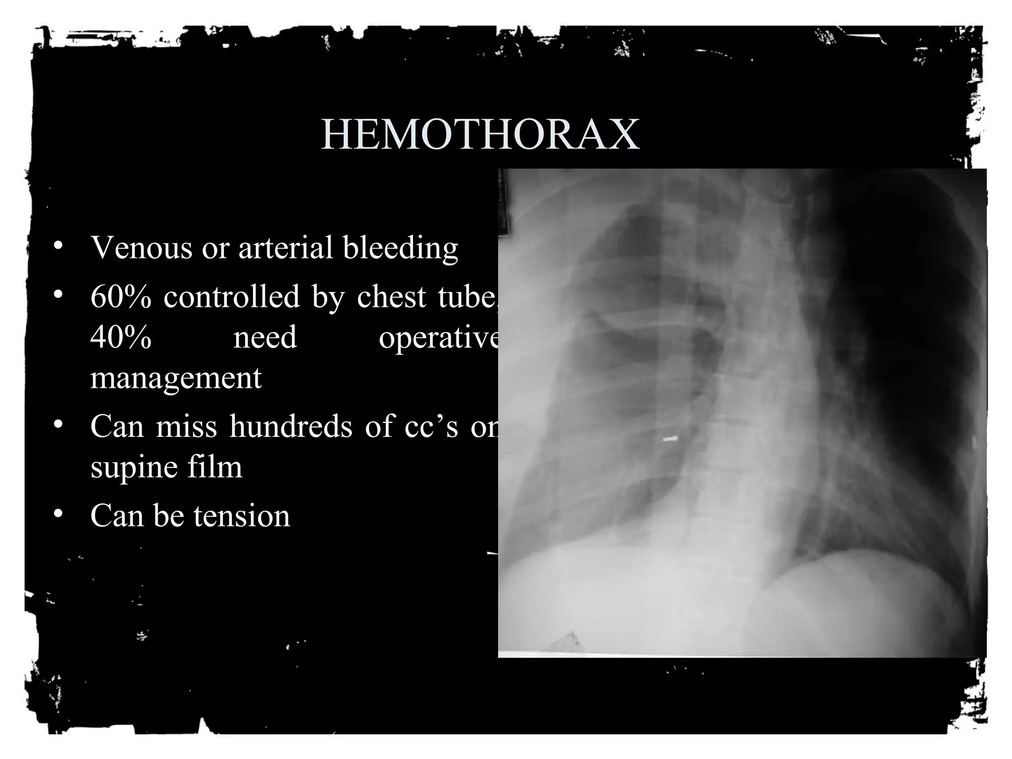 HEMOTHORAX 
• Venous or arterial bleeding 
• 60% controlled by chest tube, 
40% need operative 
management 
• Can miss hundreds of cc’s on 
supine film 
• Can be tension 
 