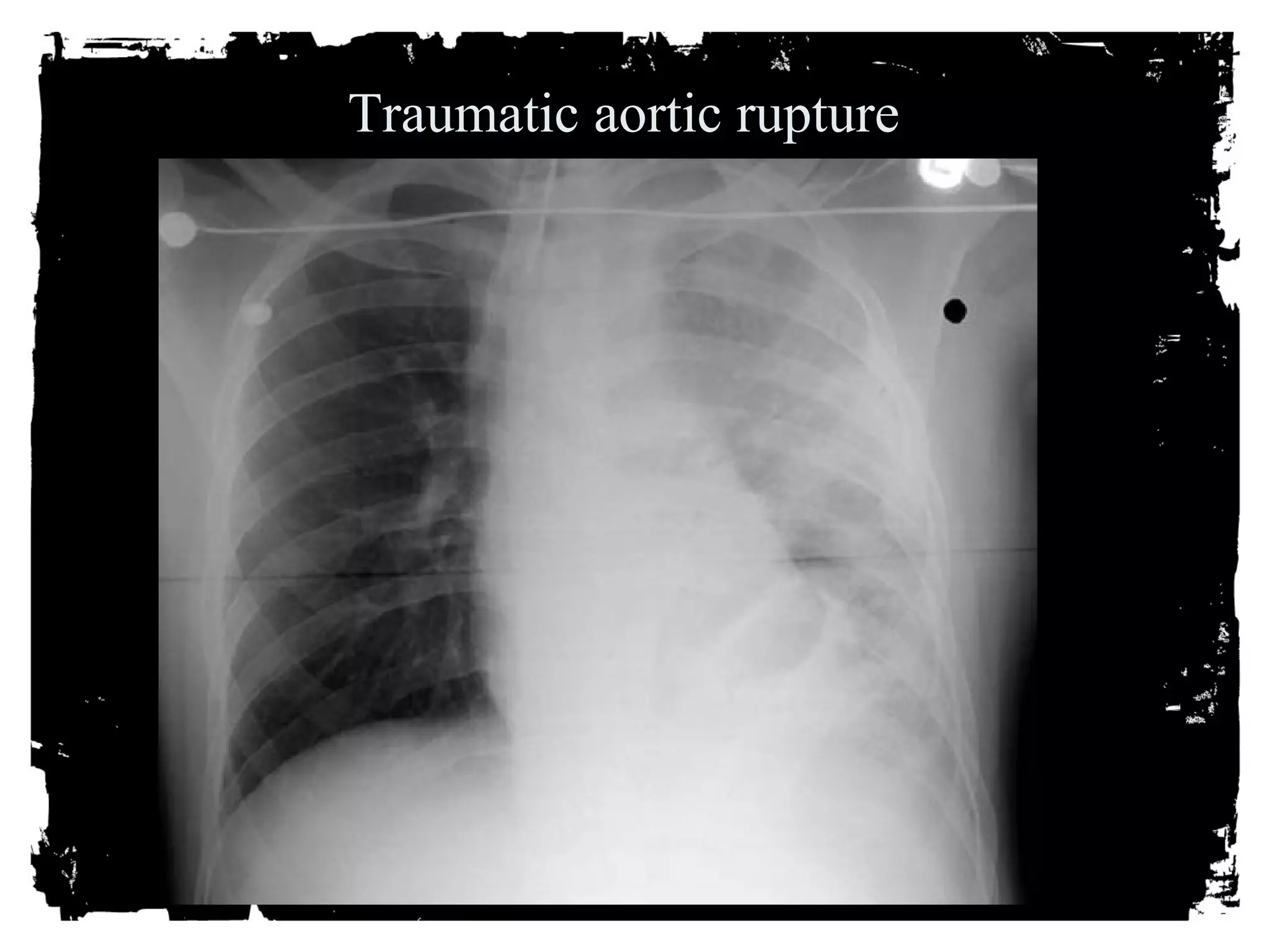 Traumatic aortic rupture 
 