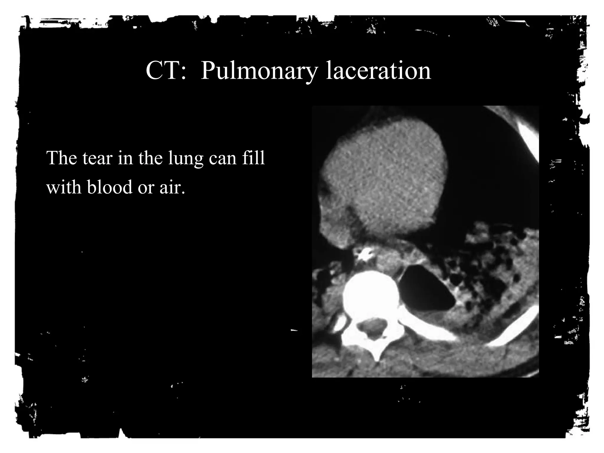 CT: Pulmonary laceration 
The tear in the lung can fill 
with blood or air. 
 