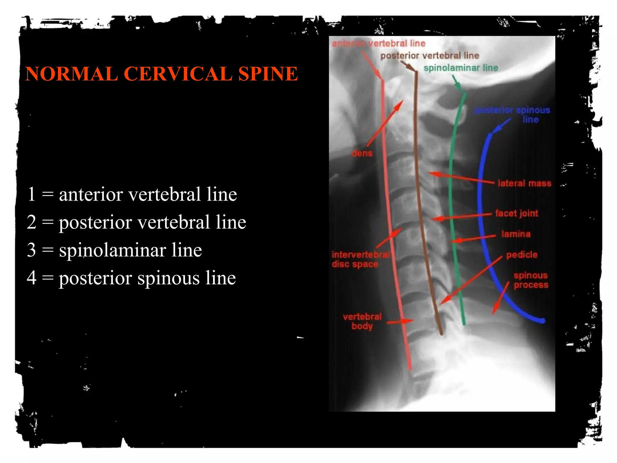 NNOORRMMAALL CCEERRVVIICCAALL SSPPIINNEE 
1 = anterior vertebral line 
2 = posterior vertebral line 
3 = spinolaminar line 
4 = posterior spinous line 
RP 
 
