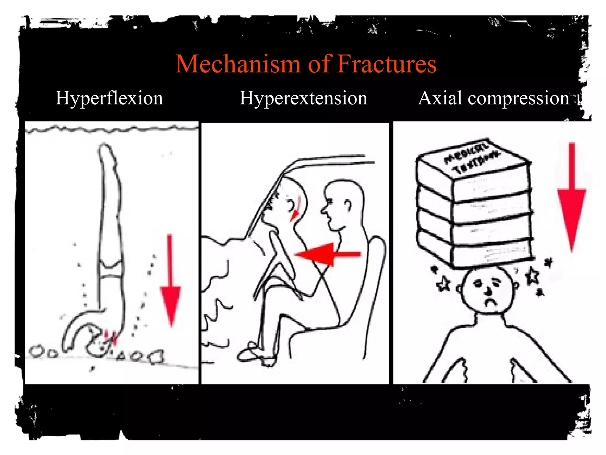 Mechanism of Fractures 
Hyperflexion Hyperextension Axial compression 
 