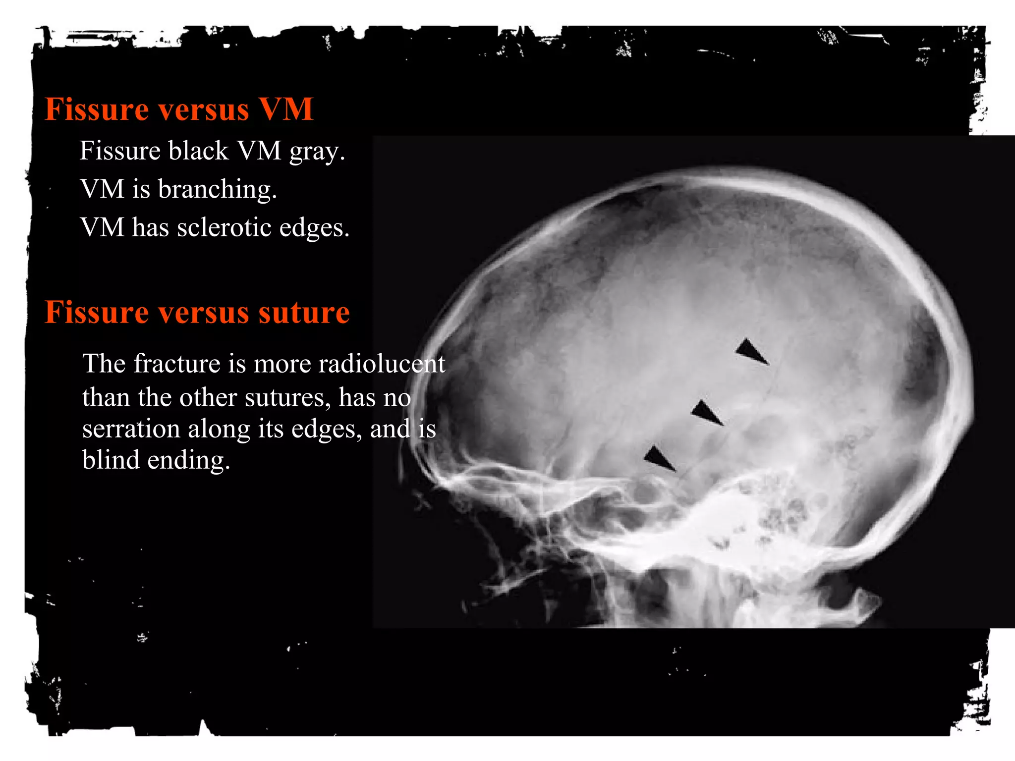 Fissure versus VM 
Fissure black VM gray. 
VM is branching. 
VM has sclerotic edges. 
Fissure versus suture 
The fracture is more radiolucent 
than the other sutures, has no 
serration along its edges, and is 
blind ending. 
 