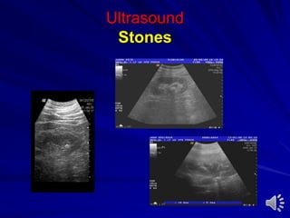 Ultrasound
Stones
 