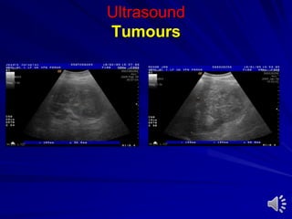 Ultrasound
Tumours
 