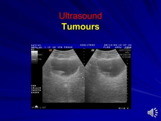 Ultrasound
Tumours
 
