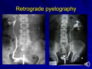 Retrograde pyelography
 