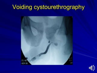 Voiding cystourethrography
 