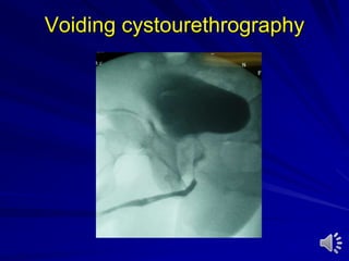 Voiding cystourethrography
 