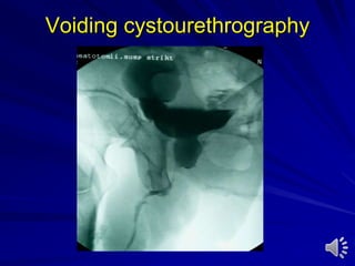 Voiding cystourethrography
 