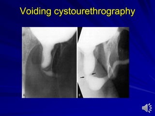 Voiding cystourethrography
 
