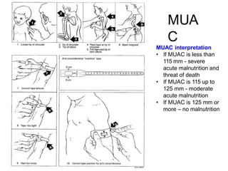MUA
C
MUAC interpretation
• If MUAC is less than
115 mm - severe
acute malnutrition and
threat of death
• If MUAC is 115 up to
125 mm - moderate
acute malnutrition
• If MUAC is 125 mm or
more – no malnutrition
 