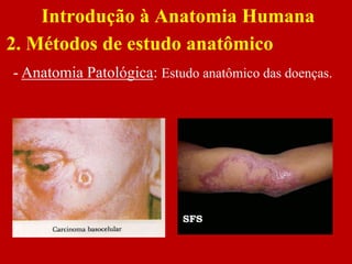 Introdução à Anatomia Humana
2. Métodos de estudo anatômico
- Anatomia Patológica: Estudo anatômico das doenças.
 