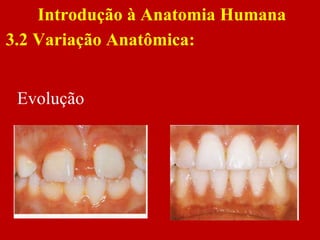 Evolução
Introdução à Anatomia Humana
3.2 Variação Anatômica:
 