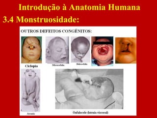 Introdução à Anatomia Humana
3.4 Monstruosidade:
 