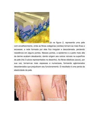Já na figura 2, representa uma pele
com envelhecimento, onde as fibras colágenas (verdes) tornam-se mais finas e
escassas; a rede formada por elas fica irregular e desordenada, perdendo
resistência em alguns pontos. Nesses pontos, a epiderme e a parte mais alta
da derme acabam desabando, dando origem aos sulcos visíveis na superfície
da pele (há 2 sulcos representados no desenho). As fibras elásticas (azuis), por
sua vez, tornam-se mais espessas e numerosas, formando aglomerados
desordenados que prejudicam seu funcionamento. O resultado é uma perda da
elasticidade da pele.
 
