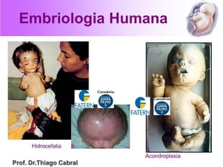Embriologia Humana
Hidrocefalia
Acondroplasia
Prof. Dr.Thiago Cabral
 