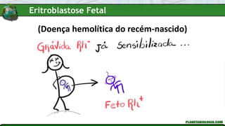 (Doença hemolítica do recém-nascido)
Eritroblastose Fetal
 