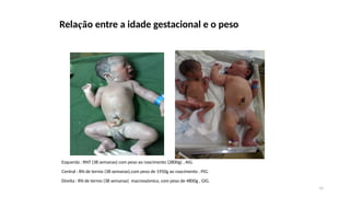 39
Relação entre a idade gestacional e o peso
Esquerda : RNT (38 semanas) com peso ao nascimento (2800g) , AIG.
Central : RN de termo (38 semanas),com peso de 1950g ao nascimento , PIG.
Direita : RN de termo (38 semanas) macrossómico, com peso de 4800g , GIG.
 