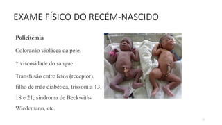 52
EXAME FÍSICO DO RECÉM-NASCIDO
Policitémia
Coloração violácea da pele.
↑ viscosidade do sangue.
Transfusão entre fetos (receptor),
filho de mãe diabética, trissomia 13,
18 e 21; sindroma de Beckwith-
Wiedemann, etc.
 