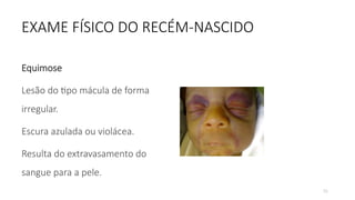 55
EXAME FÍSICO DO RECÉM-NASCIDO
Equimose
Lesão do tipo mácula de forma
irregular.
Escura azulada ou violácea.
Resulta do extravasamento do
sangue para a pele.
 