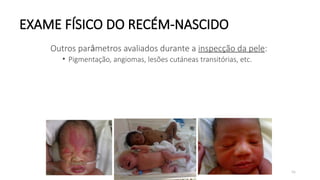 56
EXAME FÍSICO DO RECÉM-NASCIDO
Outros parâmetros avaliados durante a inspecção da pele:
• Pigmentação, angiomas, lesões cutáneas transitórias, etc.
 