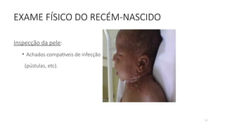 57
EXAME FÍSICO DO RECÉM-NASCIDO
Inspecção da pele:
• Achados compativeis de infecção
(pústulas, etc).
 