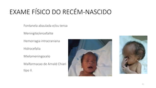 61
EXAME FÍSICO DO RECÉM-NASCIDO
Fontanela abaulada e/ou tensa
Meningite/encefalite
Hemorragia intracraniana
Hidrocefalia
Mielomeningocelo
Malformacao de Arnald Chiari
tipo II.
 