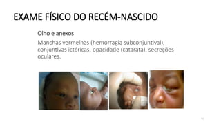 62
EXAME FÍSICO DO RECÉM-NASCIDO
Olho e anexos
Manchas vermelhas (hemorragia subconjuntival),
conjuntivas ictéricas, opacidade (catarata), secreções
oculares.
 