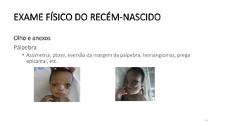 64
EXAME FÍSICO DO RECÉM-NASCIDO
Olho e anexos
Pálpebra
• Assimetria, ptose, eversão da margem da pálpebra, hemangiomas, prega
epicantal, etc.
 