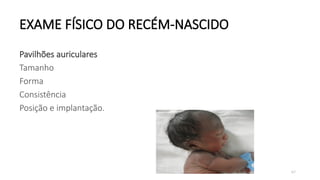 67
EXAME FÍSICO DO RECÉM-NASCIDO
Pavilhões auriculares
Tamanho
Forma
Consistência
Posição e implantação.
 