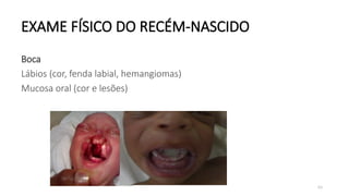 69
EXAME FÍSICO DO RECÉM-NASCIDO
Boca
Lábios (cor, fenda labial, hemangiomas)
Mucosa oral (cor e lesões)
 