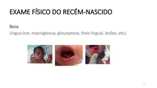 70
EXAME FÍSICO DO RECÉM-NASCIDO
Boca
Língua (cor, macroglossia, glossoptose, freio lingual, lesões, etc).
 