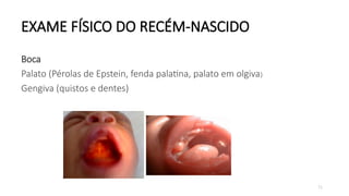 71
EXAME FÍSICO DO RECÉM-NASCIDO
Boca
Palato (Pérolas de Epstein, fenda palatina, palato em olgiva)
Gengiva (quistos e dentes)
 