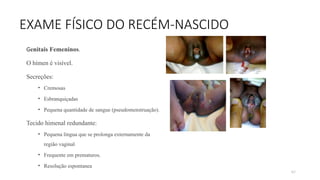 87
EXAME FÍSICO DO RECÉM-NASCIDO
Genitais Femeninos.
O hímen é visível.
Secreções:
• Cremosas
• Esbranquiçadas
• Pequena quantidade de sangue (pseudomenstruação).
Tecido himenal redundante:
• Pequena língua que se prolonga externamente da
região vaginal
• Frequente em prematuros.
• Resolução espontanea
 