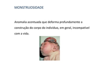 MONSTRUOSIDADE


Anomalia acentuada que deforma profundamente a
construção do corpo do indivíduo, em geral, incompatível
com a vida.
 