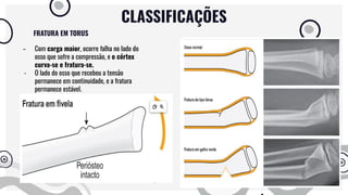 - Com carga maior, ocorre falha no lado do
osso que sofre a compressão, e o córtex
curva-se e fratura-se.
- O lado do osso que recebeu a tensão
permanece em continuidade, e a fratura
permanece estável.
FRATURA EM TORUS
CLASSIFICAÇÕES
 