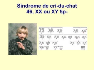 Síndrome de cri-du-chat
46, XX ou XY 5p-
 