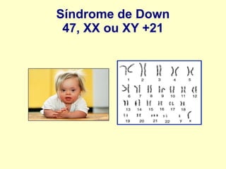 Síndrome de Down
47, XX ou XY +21
 