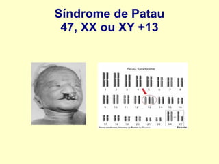 Síndrome de Patau
47, XX ou XY +13
 