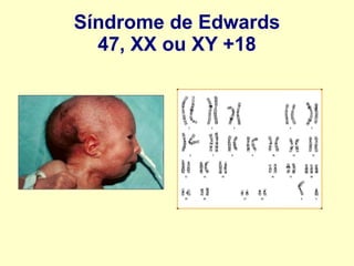 Síndrome de Edwards
47, XX ou XY +18
 